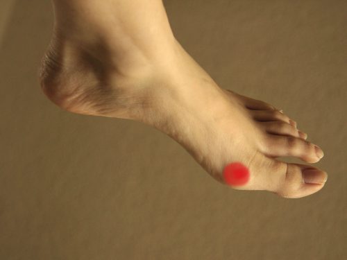 Co to jest stopa moczanowa?